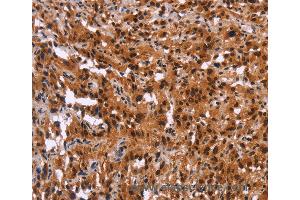 Immunohistochemistry of Human thyroid cancer using GPR124 Polyclonal Antibody at dilution of 1:40 (GPR124 抗体)