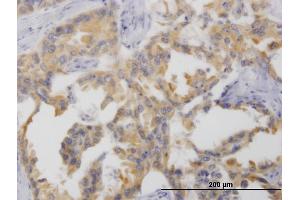 Immunoperoxidase of monoclonal antibody to NTNG2 on formalin-fixed paraffin-embedded human lung cancer. (Netrin G2 抗体  (AA 21-119))