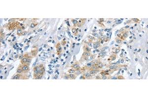 Immunohistochemistry of paraffin-embedded Human liver cancer tissue using LRP6 Polyclonal Antibody at dilution 1:60 (LRP6 抗体)