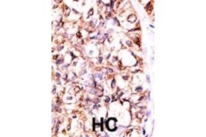 Formalin-fixed and paraffin-embedded human cancer tissue reacted with the primary antibody, which was peroxidase-conjugated to the secondary antibody, followed by AEC staining. (PP5 抗体  (C-Term))
