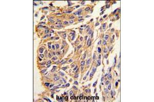 Formalin-fixed and paraffin-embedded human lung carcinoma tissue reacted with PPT1 antibody , which was peroxidase-conjugated to the secondary antibody, followed by DAB staining. (PPT1 抗体  (C-Term))