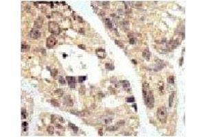 IHC analysis of FFPE human breast carcinoma tissue stained with the SUMO1 antibodyFITC-conjugated goat-anti-rabbit secondary Ab was used for the analysis. (SUMO1 抗体  (AA 1-30))