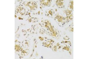 Immunohistochemistry of paraffin-embedded human breast using CASP2 Antibody (ABIN5973353) at dilution of 1/100 (40x lens). (Caspase 2 抗体)