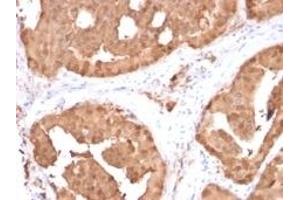 Formalin-fixed, paraffin-embedded human prostate carcinoma stained with Glyoxalase 1 (GLO1) Mouse Monoclonal Antibody (CPTC-GLO1-1). (GLO1 抗体)