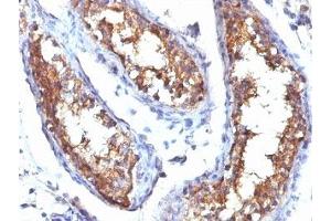 Formalin-fixed, paraffin-embedded human testicular carcinoma stained with CD99 antibody (HO36-1.