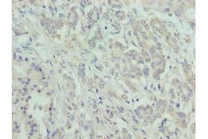 Immunohistochemistry of paraffin-embedded human pancreatic cancer using ABIN7144801 at dilution of 1:100 (ATXN7L1 抗体  (AA 1-146))