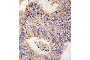 Formalin-fixed and paraffin-embedded human colon carcinoma tissue reacted with TRAF2 antibody (C-term) (ABIN392282 and ABIN2841948) , which was peroxidase-conjugated to the secondary antibody, followed by DAB staining. (TRAF2 抗体  (C-Term))