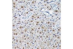 Immunohistochemistry (IHC) image for anti-6-phosphofructo-2-Kinase/fructose-2,6-Biphosphatase 3 (PFKFB3) (AA 400-500) antibody (ABIN6145485)