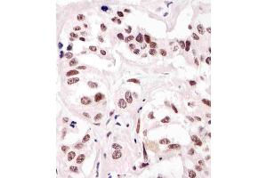 (ABIN387785 and ABIN2838022) staining SUMO1 in human breast carcinoma tissue sections by Immunohistochemistry (IHC-P - paraformaldehyde-fixed, paraffin-embedded sections). (SUMO1 抗体)