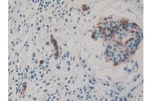 Detection of THBS3 in Human Pancreatic cancer Tissue using Polyclonal Antibody to Thrombospondin 3 (THBS3) (THBS3 抗体  (AA 670-921))