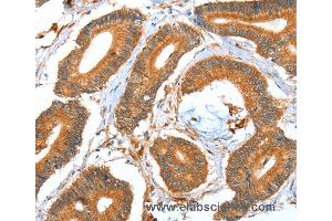 Immunohistochemistry of Human colon cancer using ACOT11 Polyclonal Antibody at dilution of 1:40 (ACOT11 抗体)