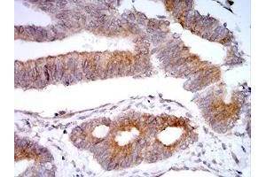 Immunohistochemical analysis of paraffin-embedded rectum cancer tissues using VIMP mouse mAb with DAB staining.
