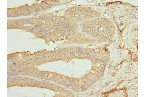 Immunohistochemistry of paraffin-embedded human endometrial cancer using ABIN7146875 at dilution of 1:100 (CSNK1G1 抗体  (Isoform gamma 1))