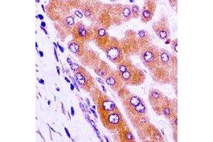 Immunohistochemical analysis of GAS2 staining in human liver cancer formalin fixed paraffin embedded tissue section. (GAS2 抗体)