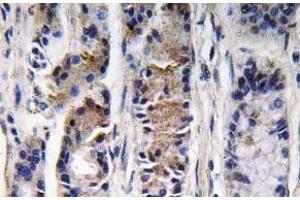 Immunohistochemistry (IHC) analyzes of Pepsin C antibody in paraffin-embedded human lung carcinoma tissue. (PGC 抗体)