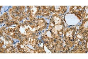Immunohistochemistry of paraffin-embedded Human thyroid cancer using ANXA3 Polyclonal Antibody at dilution of 1:35 (Annexin A3 抗体)