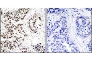 Immunohistochemistry analysis of paraffin-embedded human lung carcinoma, using Chk2 (Phospho-Thr68) Antibody. (CHEK2 抗体  (pThr68))