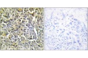Immunohistochemistry analysis of paraffin-embedded human lung carcinoma tissue, using Collagen VI alpha2 Antibody. (COL6A2 抗体  (AA 691-740))