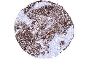 Invasive urothelial carcinoma of the kidney pelvis with strong Upk1a positivity (UPK1A 抗体  (AA 114-173))