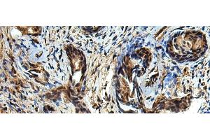 Immunohistochemistry of paraffin-embedded Human prost at e cancer tissue using TBCC Polyclonal Antibody at dilution of 1:80(x200) (TBCC 抗体)