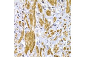 Immunohistochemistry of paraffin-embedded human stomach cancer using DSP antibody at dilution of 1:100 (40x lens). (Desmoplakin 抗体)