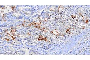 Paraffin embedded sections of human colon cancer tissue were incubated with FABP1 monoclonal antibody, clone 2G4  (1:100). (FABP1 抗体  (AA 1-127))