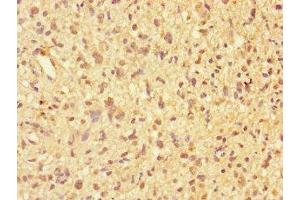 Immunohistochemistry of paraffin-embedded human glioma using ABIN7169250 at dilution of 1:100 (PPP2R2D 抗体  (Regulatory Subunit B))