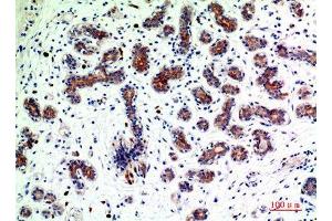 Immunohistochemistry (IHC) analysis of paraffin-embedded Human Breast Cancer, antibody was diluted at 1:200. (BMP2 抗体  (Internal Region))