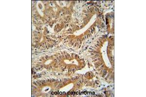 CCDC123 antibody immunohistochemistry analysis in formalin fixed and paraffin embedded human colon carcinoma followed by peroxidase conjugation of the secondary antibody and DAB staining. (CEP89 抗体  (C-Term))