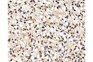 Immunohistochemistry analysis of paraffin-embedded human liver cancer using p27 Polyclonal Antibody at dilution of 1:200. (P27 抗体)