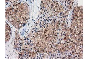 Immunohistochemical staining of paraffin-embedded Adenocarcinoma of Human breast tissue using anti-DSTN mouse monoclonal antibody. (Destrin 抗体)