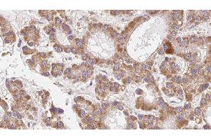 ABIN6279259 at 1/100 staining Human liver cancer tissue by IHC-P. (CEACAM20 抗体  (Internal Region))