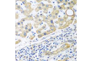 Immunohistochemistry of paraffin-embedded human liver cancer using GLUD1 antibody (ABIN5975614) at dilution of 1/100 (40x lens). (GLUD1 抗体)