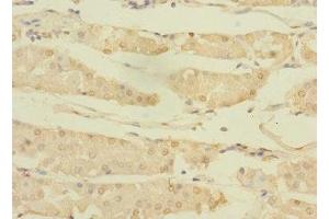Immunohistochemistry of paraffin-embedded human gastric cancer using ABIN7144765 at dilution of 1:100 (ASTL 抗体  (AA 38-337))