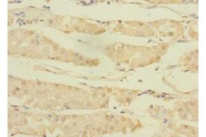 Immunohistochemistry of paraffin-embedded human gastric cancer using ABIN7144765 at dilution of 1:100 (ASTL 抗体  (AA 38-337))