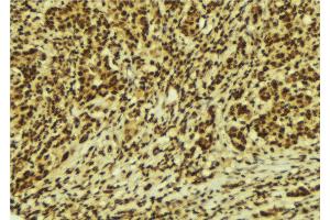 ABIN6269320 at 1/100 staining Human breast cancer tissue by IHC-P. (c-Rel 抗体  (Internal Region))