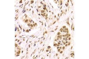 Immunohistochemistry of paraffin-embedded human breast cancer using HMGB1 Antibody. (HMGB1 抗体  (AA 100-200))