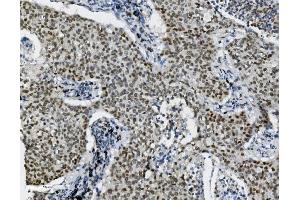 IHC analysis of Transketolase/TKT using anti-Transketolase/TKT antibody (ABIN7598957).