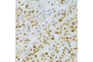 Immunohistochemistry of paraffin-embedded human liver cancer using DKC1 Antibody (ABIN5970956) at dilution of 1/200 (40x lens). (DKC1 抗体)