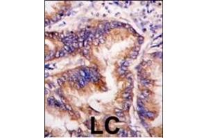 Formalin-fixed and paraffin-embedded human lung carcinoma tissue reacted with EIF2AK1 antibody (Center), which was peroxidase-conjugated to the secondary antibody, followed by DAB staining. (EIF2AK1 抗体  (AA 267-296))