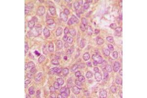 Immunohistochemical analysis of PKR staining in human breast cancer formalin fixed paraffin embedded tissue section.