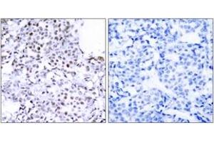 Immunohistochemistry analysis of paraffin-embedded human breast carcinoma tissue, using SMC1 (Ab-957) Antibody. (SMC1A 抗体  (AA 931-980))