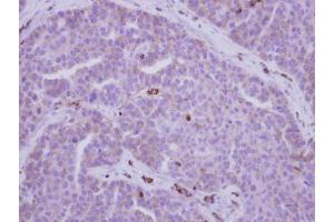 IHC-P Image Immunohistochemical analysis of paraffin-embedded human adenocarcinoma, using MYH9, antibody at 1:500 dilution. (Myosin 9 抗体  (N-Term))