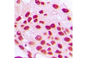 Immunohistochemical analysis of HOXC6 staining in human prostate cancer formalin fixed paraffin embedded tissue section. (Homeobox C6 抗体  (C-Term))