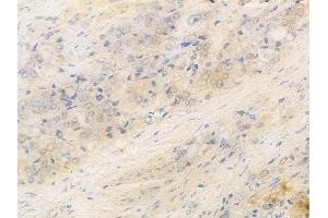 ABIN6266061 and ABIN6269302 at 1/100 staining human prostate carcinoma by IHC-P. (XIAP 抗体  (N-Term))