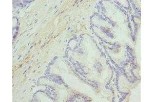 Immunohistochemistry of paraffin-embedded human prostate cancer using ABIN7149844 at dilution of 1:100 (DGKA 抗体  (AA 1-200))