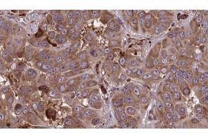 ABIN6273858 at 1/100 staining Human liver cancer tissue by IHC-P. (GPR161 抗体  (Internal Region))
