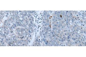Immunohistochemistry of paraffin-embedded Human liver cancer tissue using NF1 Polyclonal Antibody at dilution of 1:65(x200) (Neurofibromin 1 抗体)