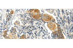 Immunohistochemistry of paraffin-embedded Human cervical cancer using MSI1 Polyclonal Antibody at dilution of 1/30 (MSI1 抗体)