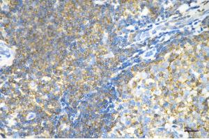 Immunohistochemistry was performed on paraffin-embedded human breast carcinoma using moesin antibody (ABIN7799482), 1:200). (Recombinant Moesin 抗体)